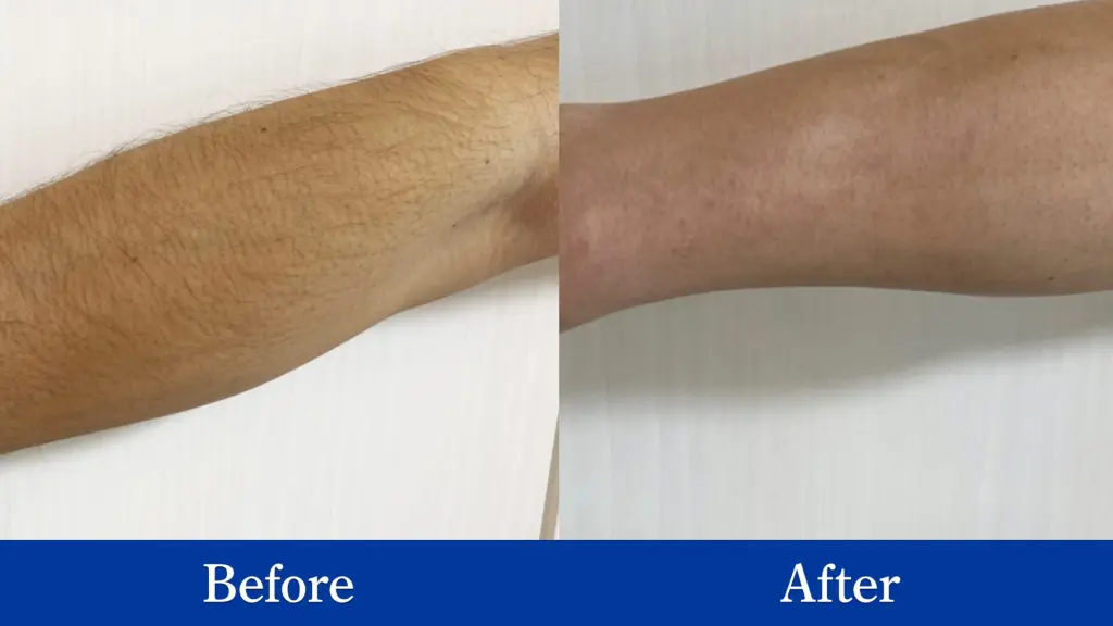 脱毛・除毛 addiction 666 Amazon.co.jp: 【2025業界注目！痛くない次世代モデル】脱毛器 擦る