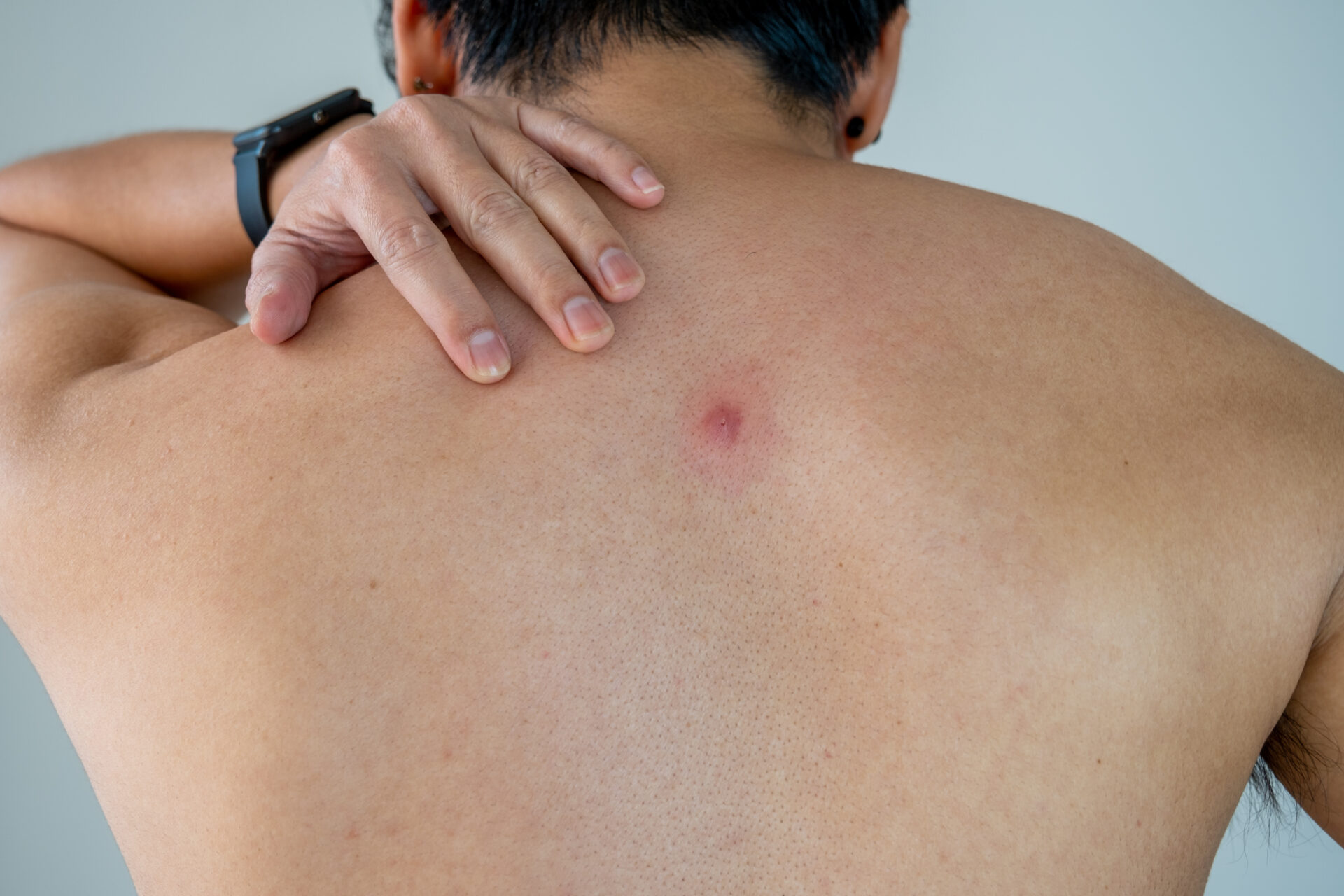 背中ニキビの意外な落とし穴とは？原因と正しい対策を徹底解説｜ATRIUM HOMME 恵比寿