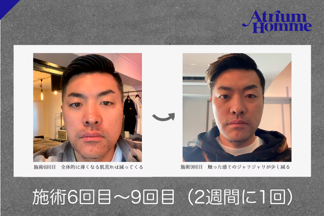 【髭脱毛のリアル②】9回でここまで変わる！ビフォーアフター体験記｜ATRIUM HOMME 恵比寿