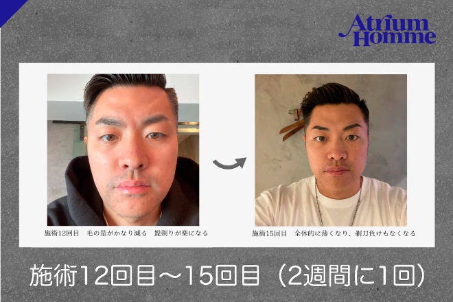 【髭脱毛のリアル③】15回でここまで変わる！ビフォーアフター体験記｜ATRIUM HOMME 恵比寿
