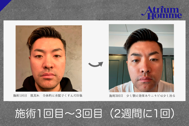 【髭脱毛のリアル①】3回でここまで変わる！ビフォーアフター体験記｜ATRIUM HOMME 恵比寿