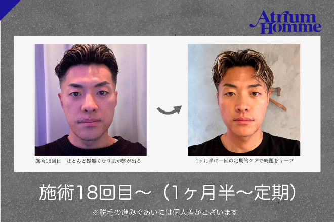 【髭脱毛のリアル④】18回目〜の経過レポート公開！長年のコンプレックス解消！？