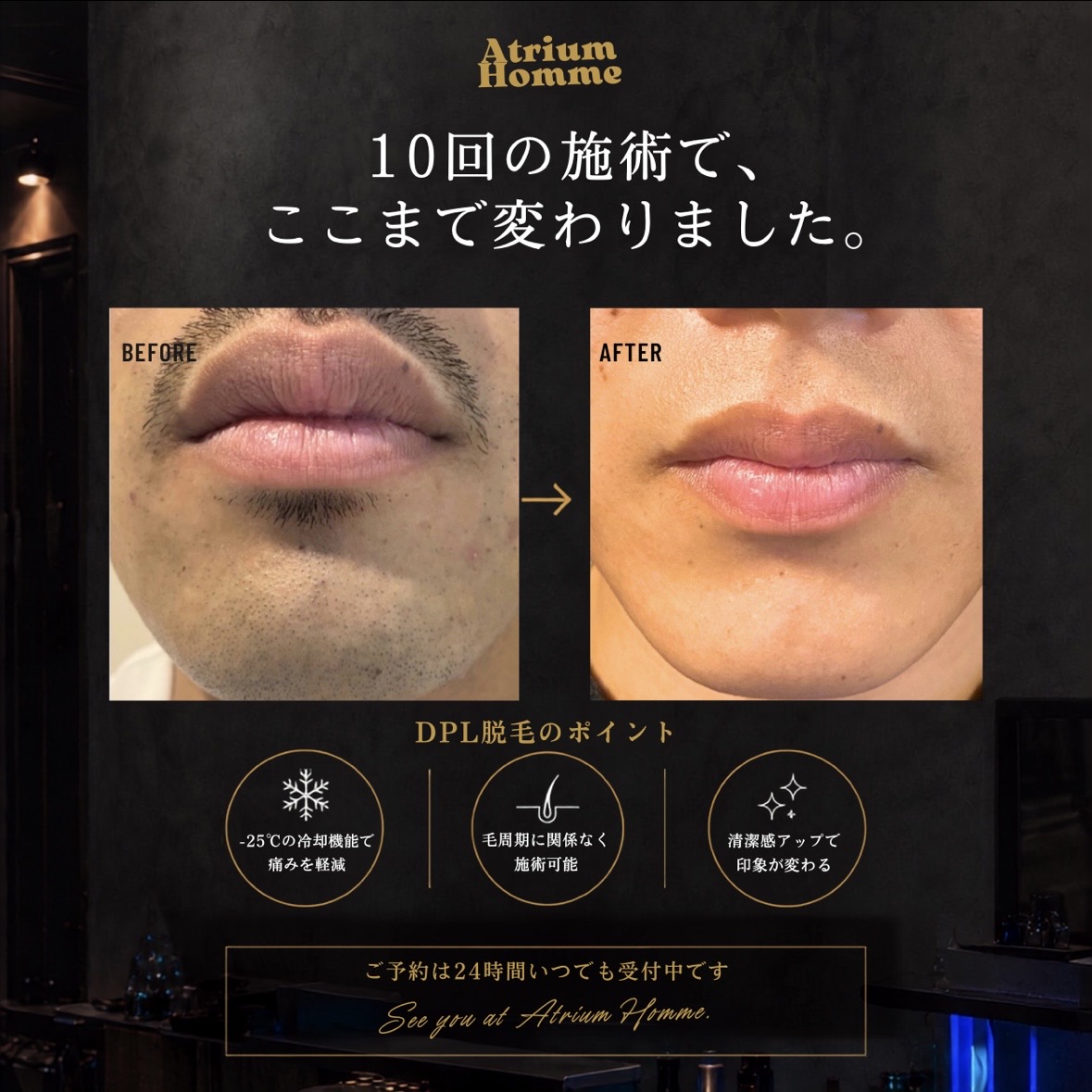 ヒゲ脱毛10回の変化|青ヒゲが気になる男性の施術事例